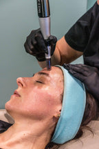 Skin Needling
