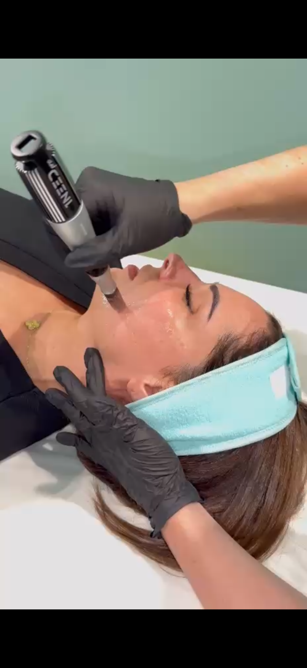 Skin Needling