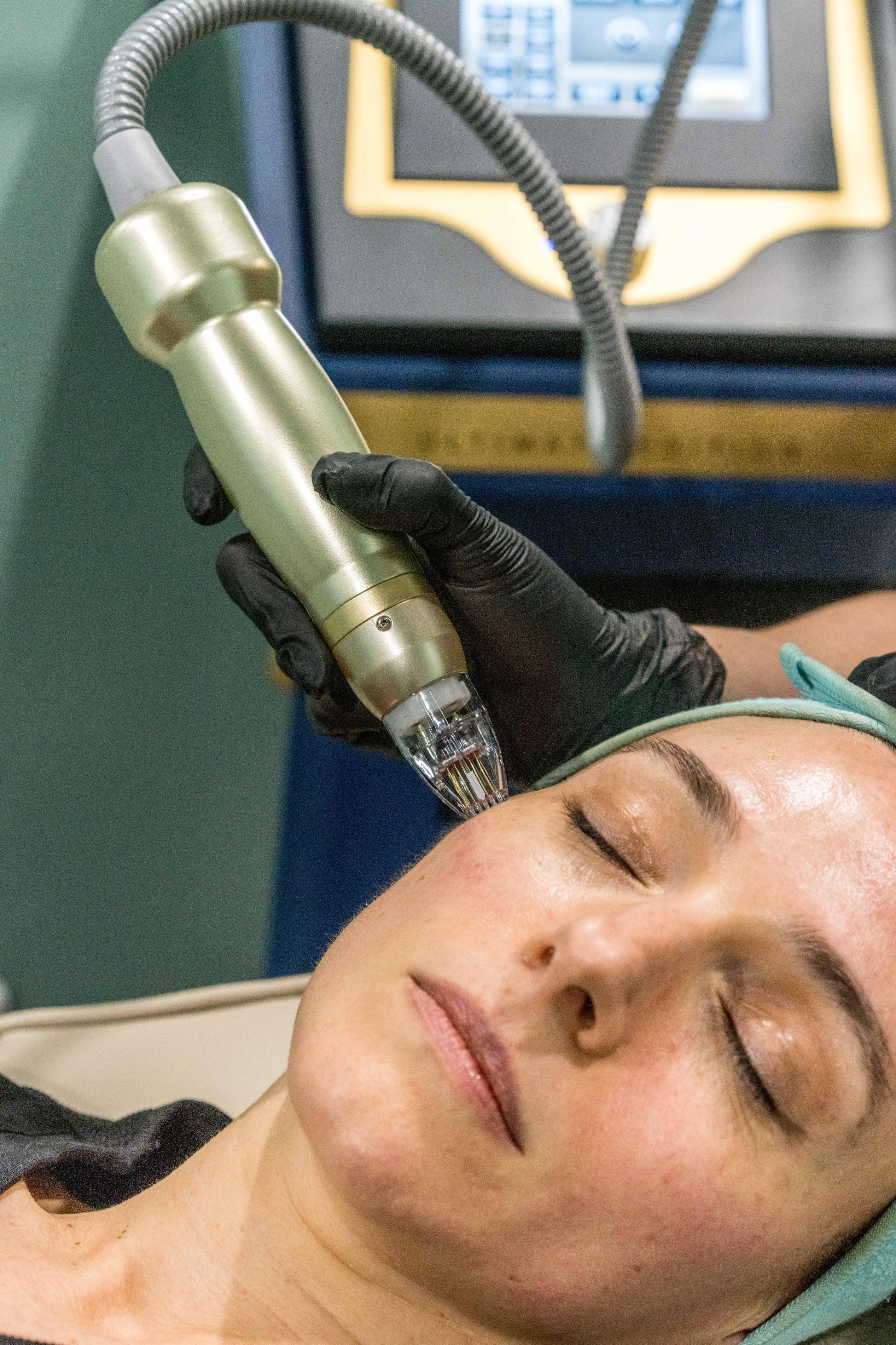 RF Microneedling’